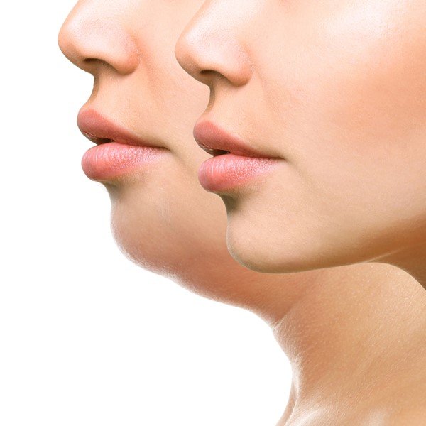 Double chin treatment